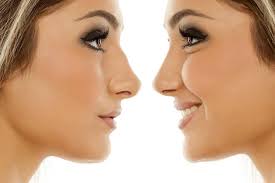 Nuanced Beauty: Ethnic Rhinoplasty in Los Angeles post thumbnail image